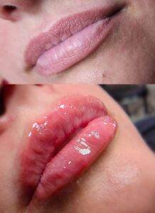 Before and after images of a satisfied client who underwent hyaluronic acid lip filler treatment.